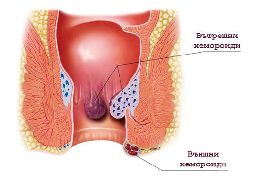 Как по естествен начин да се справим с Хемороидите?!